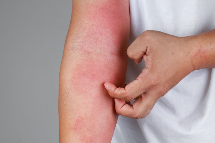 7 types of eczema