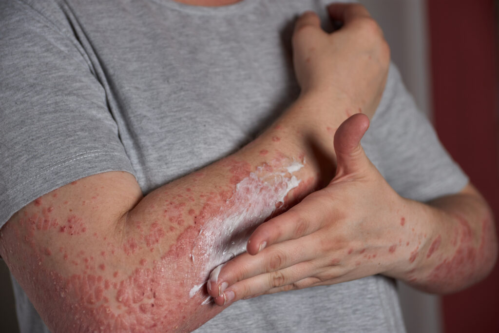 shingles stages treatment