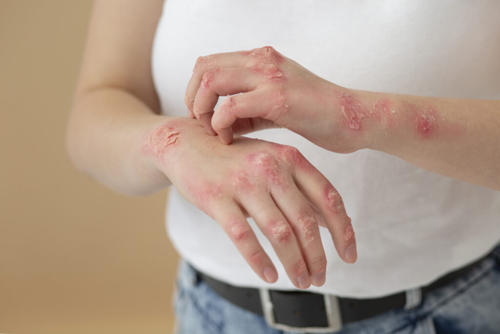 what can be mistaken for herpes