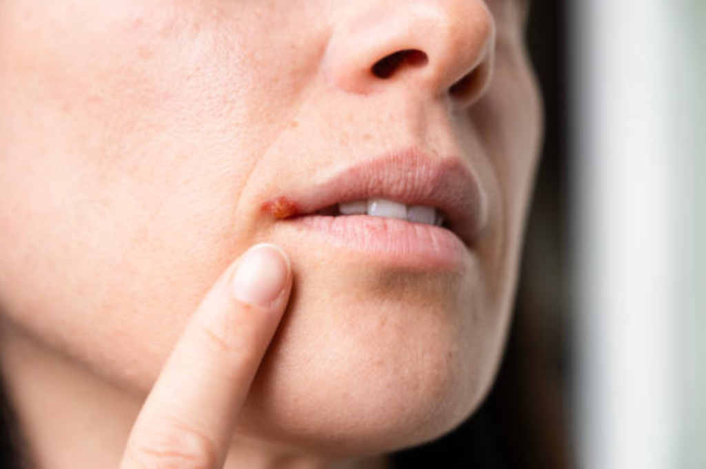 fever blister